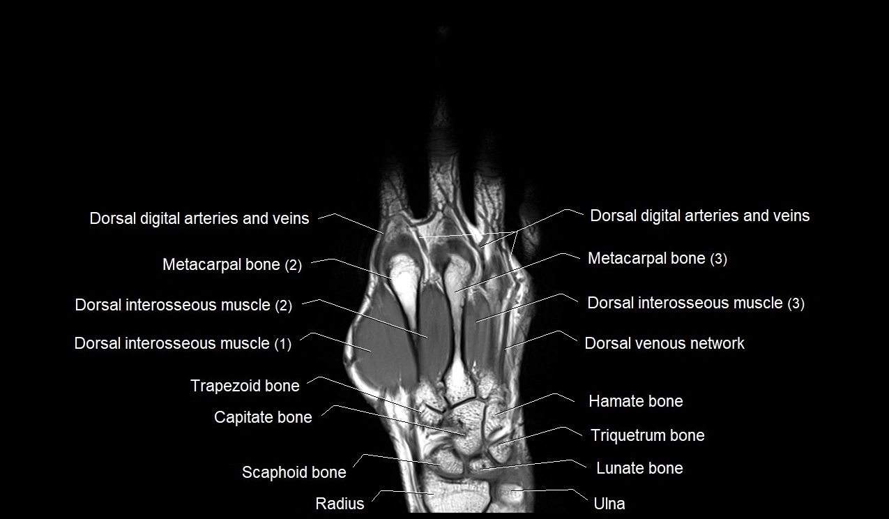 MRI 3T coronal hand cross sectional anatomy image 14.webp